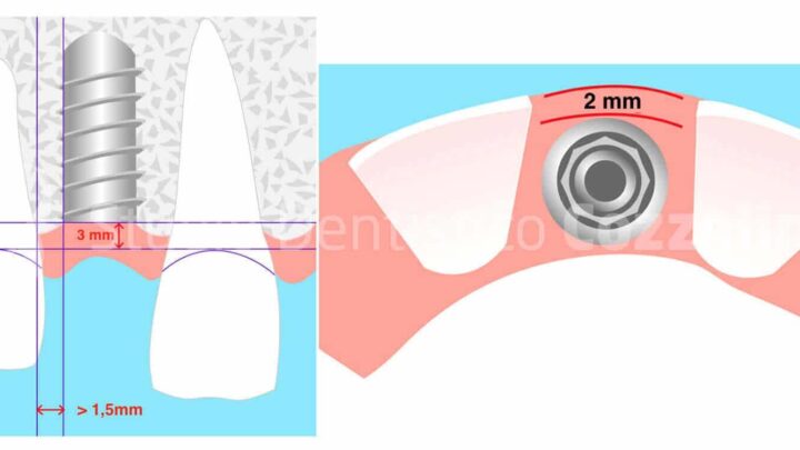 Posizionamento implantare e densità ossea, quale connessione?