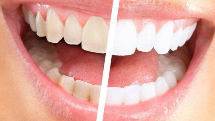 Sbiancamento dentale: un servizio determinante per il tuo studio dentistico